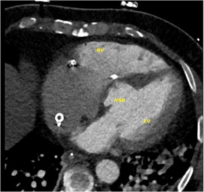 Case report—CARMAT: the first experience with the Aeson bioprosthetic total artificial heart as a bridge to transplantation in a case of post-infarction ventricular septal rupture